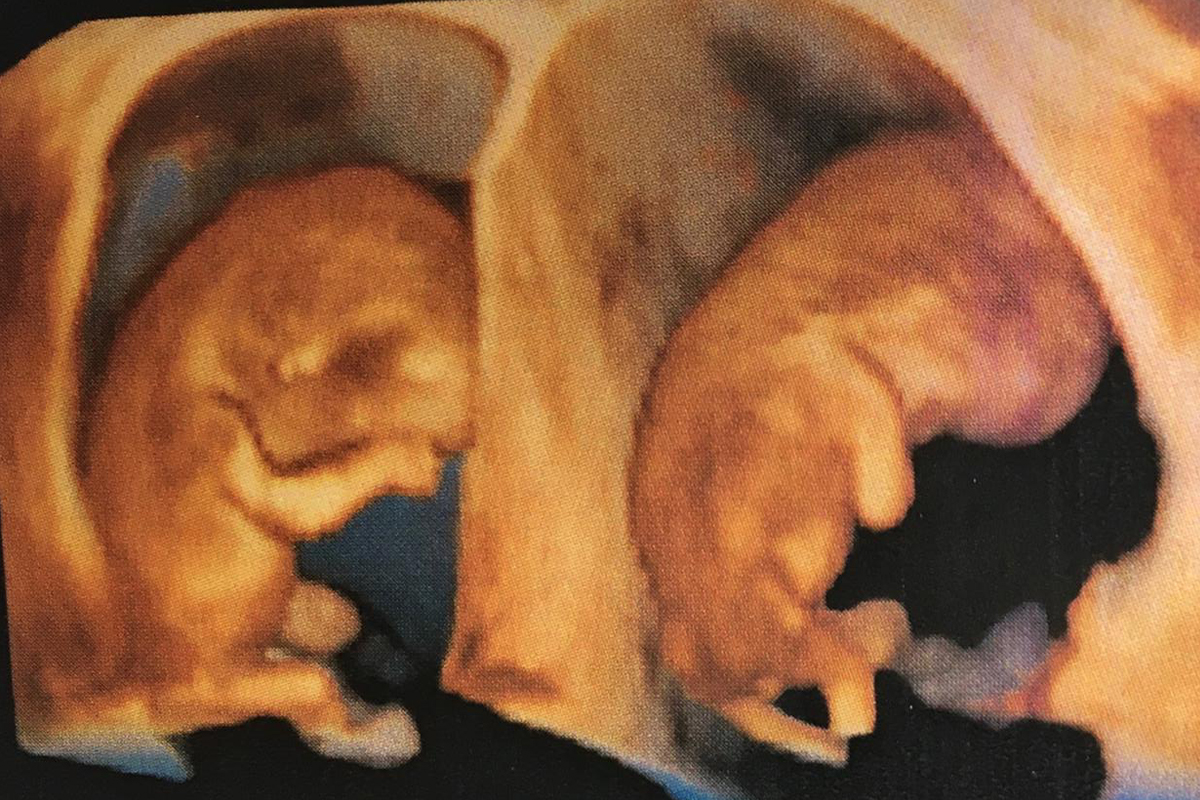 Acompanhamento ultrassonográfico para gestações gemelares - Essenza